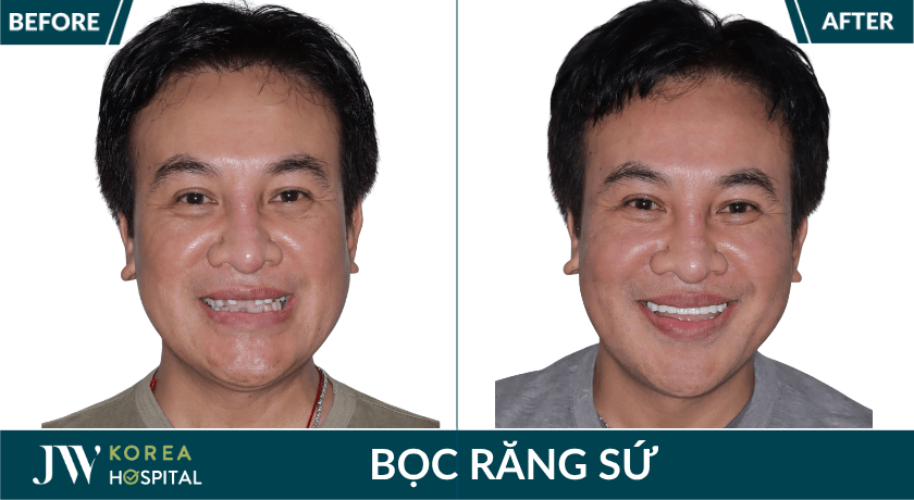 khách hàng bọc răng sứ kim cương jw diamond smile tại JW