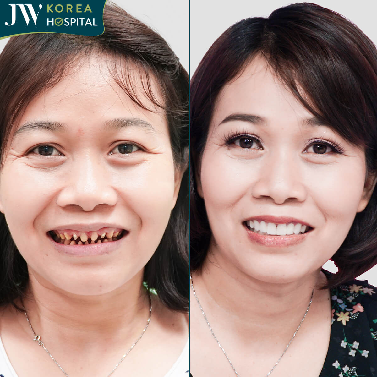 hình ảnh khách hàng trước và sau bọc răng sứ kim cương tại JW