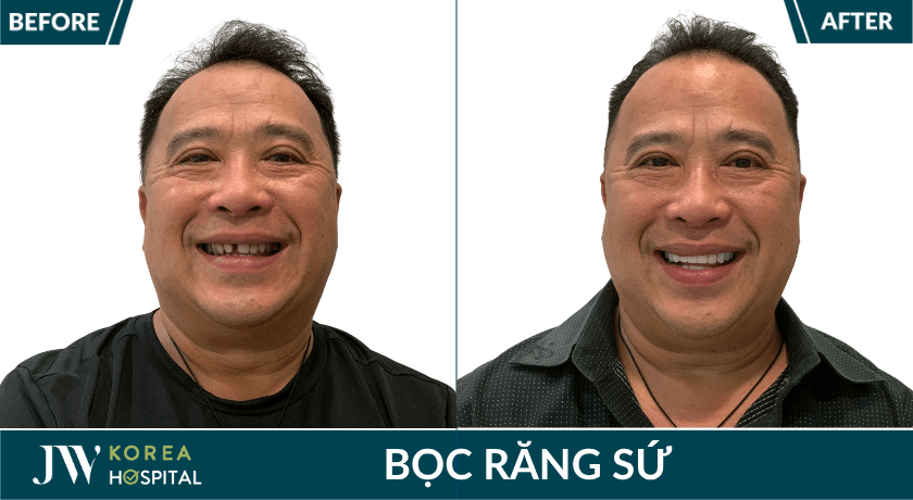 khách hàng bọc răng sứ kim cương jw diamond smile tại JW