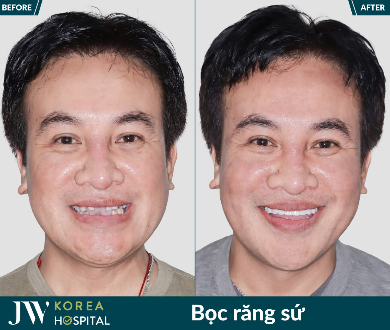 hình ảnh khách hàng trước và sau bọc răng sứ kim cương tại JW