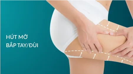 Hút mỡ bắt Tay/Đùi