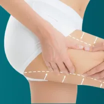 Hút mỡ bắt Tay/Đùi