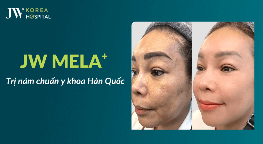 liệu trình trị nám JW Mela+ chuẩn y khoa Hàn Quốc