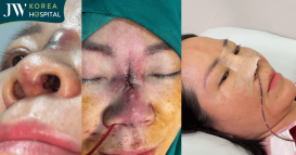 kỳ tích y khoa biến chứng nâng mũi phong thủy