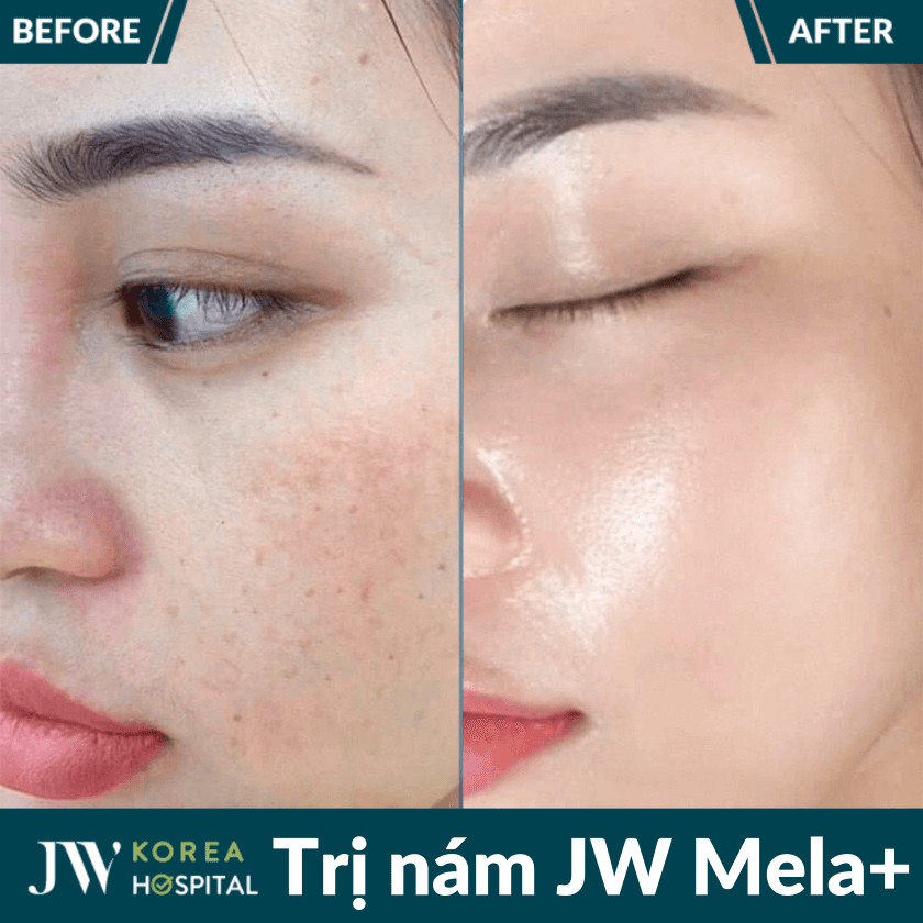 Liệu trình điều trị nám an toàn JW Mela+