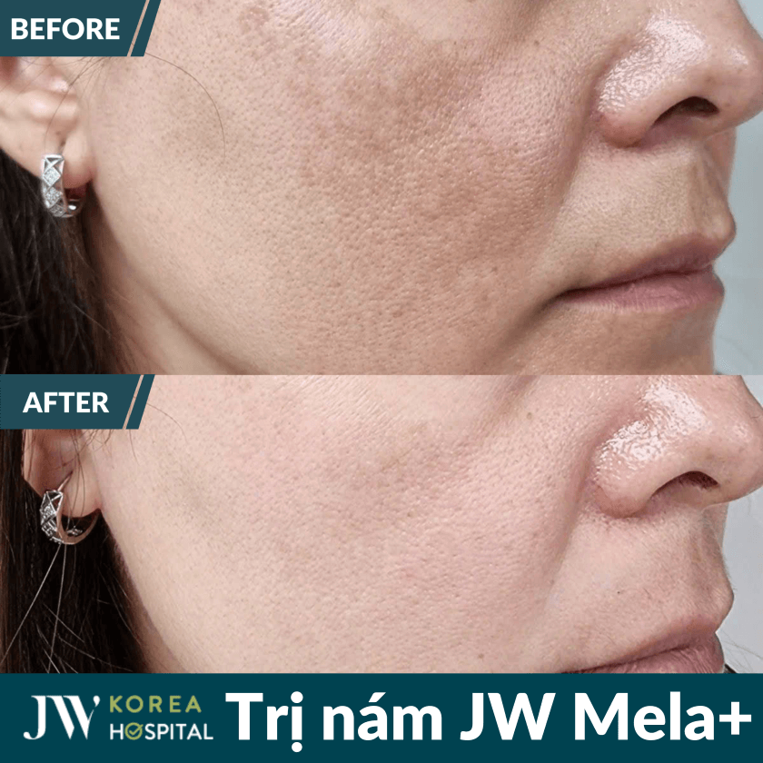 Liệu trình điều trị nám chuẩn y khoa Mela+