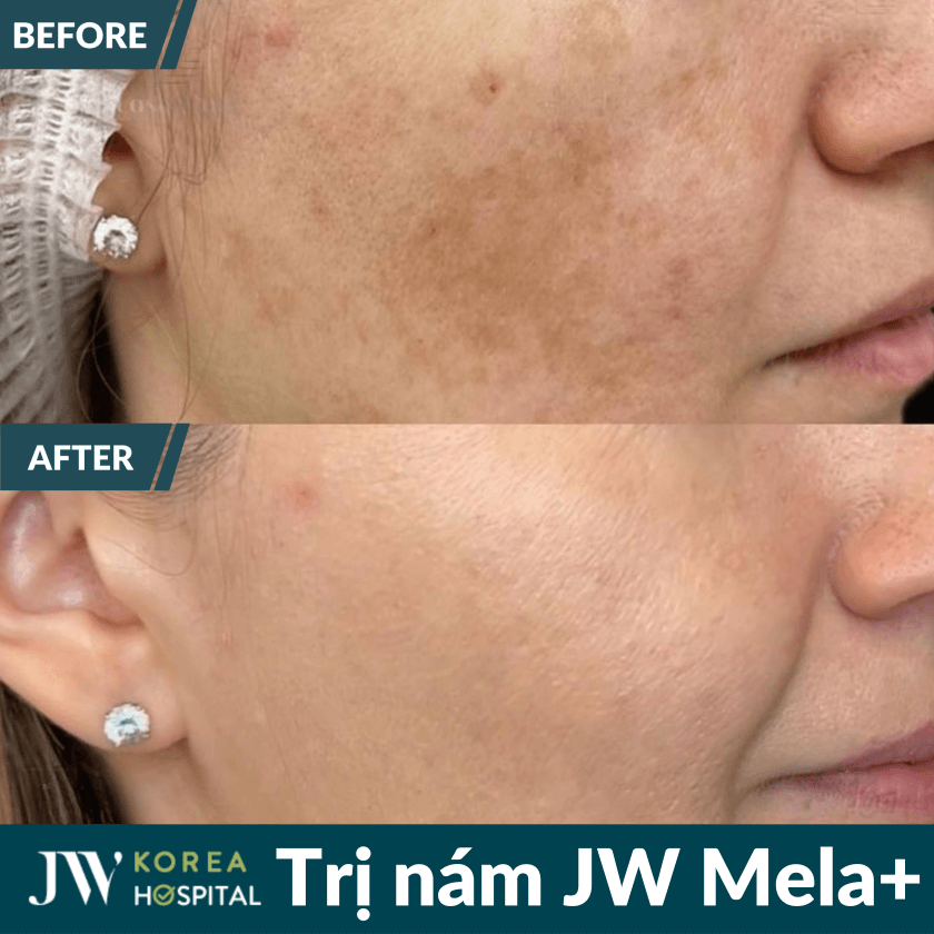 Liệu trình trị nám JW Mela+