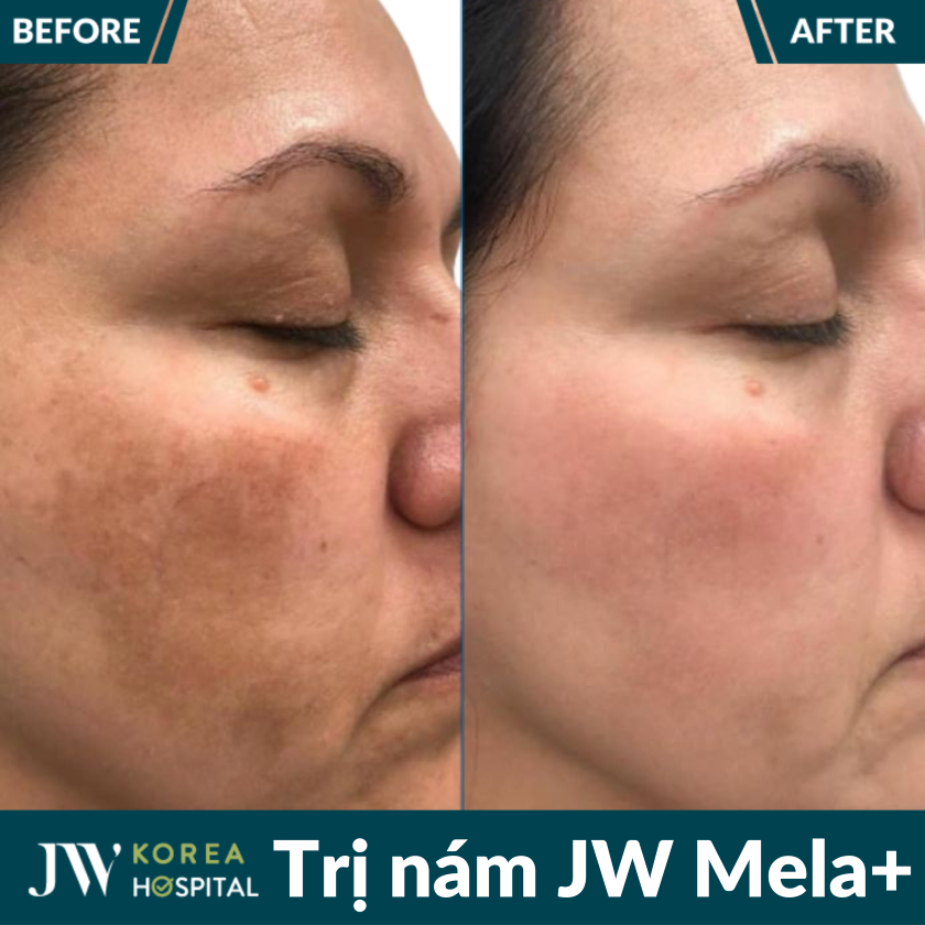 Liệu trình điều trị nám JW Mela+