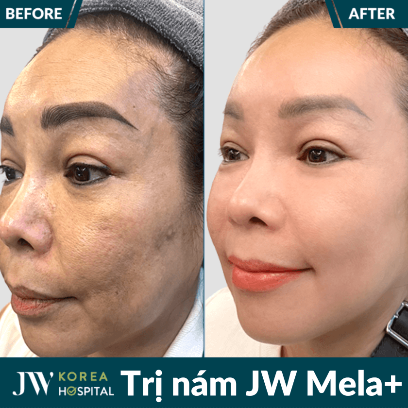 Liệu trình điều trị nám chuẩn y khoa JW Mela+ tại Bệnh viện JW 