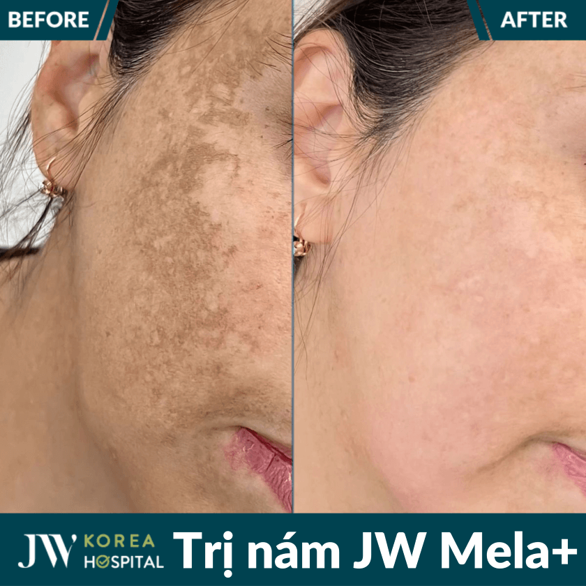 Liệu trình điều trị nám an toàn JW Mela+ tại Bệnh viện JW 