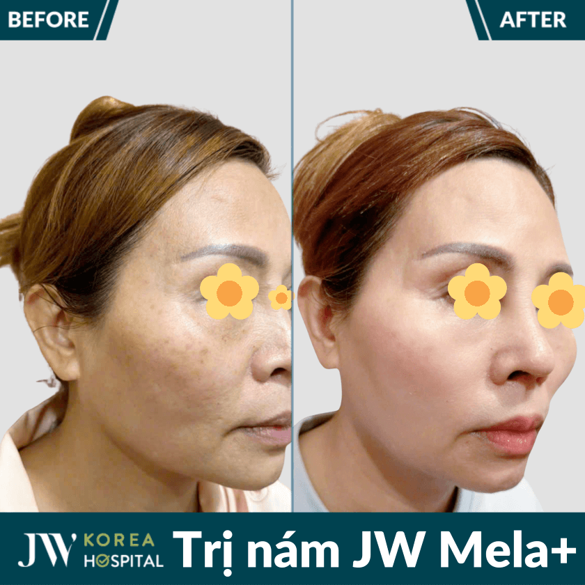 Liệu trình điều trị nám an toàn JW Mela+ tại Bệnh viện JW Hàn Quốc 