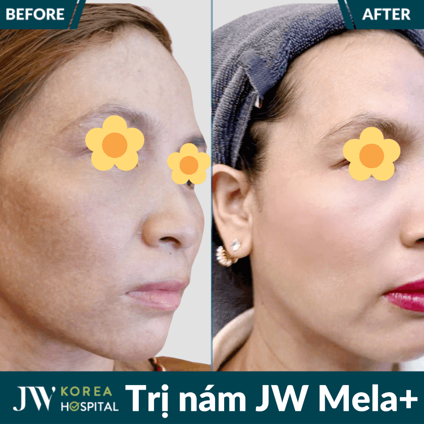 Liệu trình điều trị nám chuẩn y khoa JW Mela+ tại Bệnh viện JW Hàn Quốc