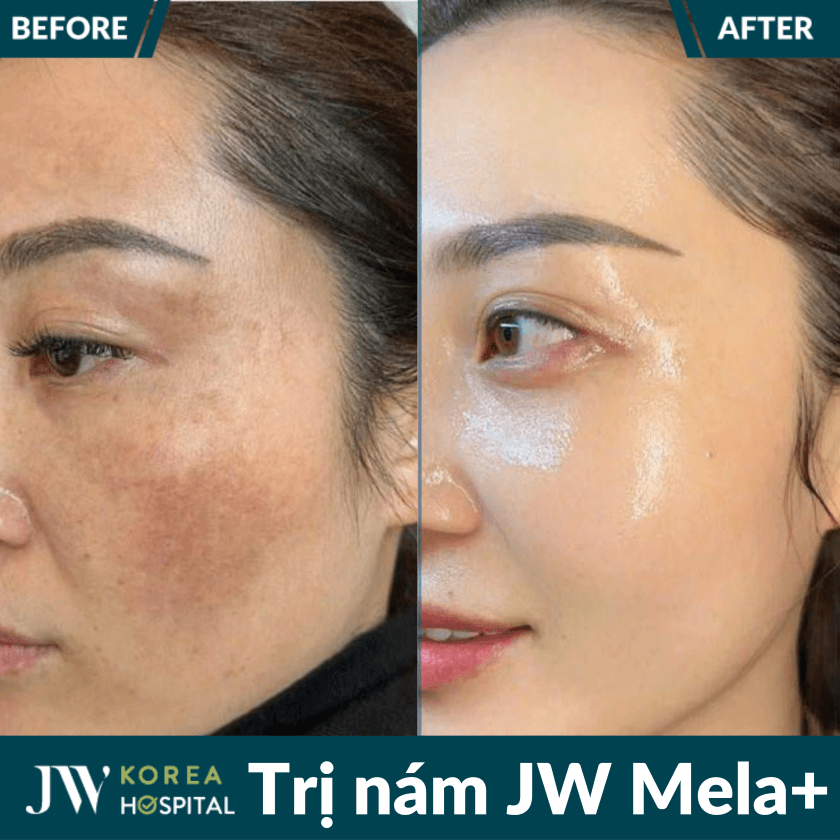 JW Mela+ liệu trình điều trị nám chuẩn y khoa tại Bệnh viện JW 