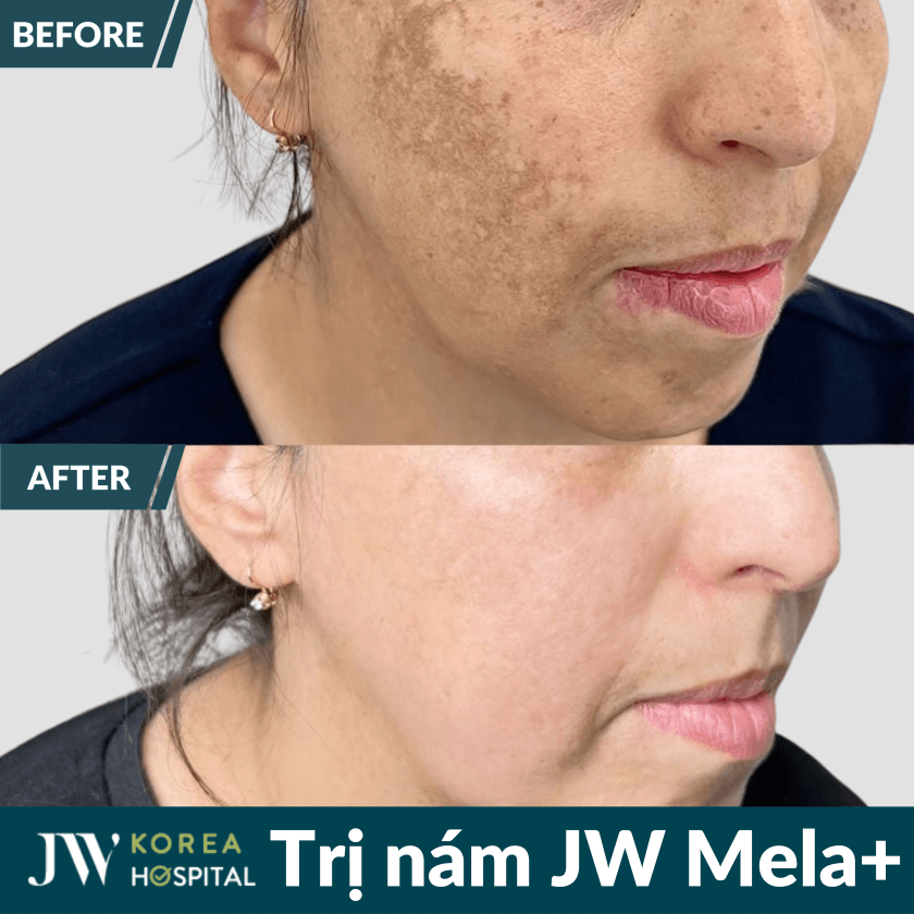 JW Mela+ liệu trình điều trị nám an toàn tại Bệnh viện JW 