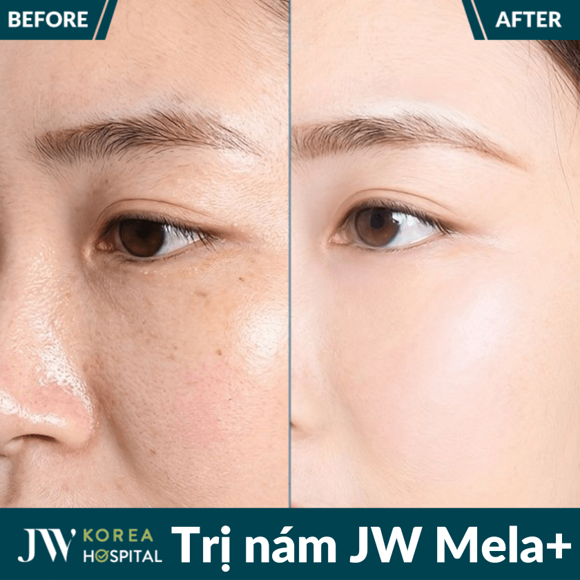 liệu trình trị nám chuẩn y khoa JW Mela+