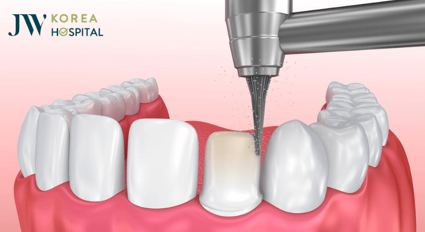 mài răng sứ để bọc răng sứ kim cương