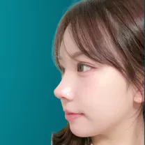 nâng mũi s line