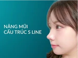 nâng mũi s line