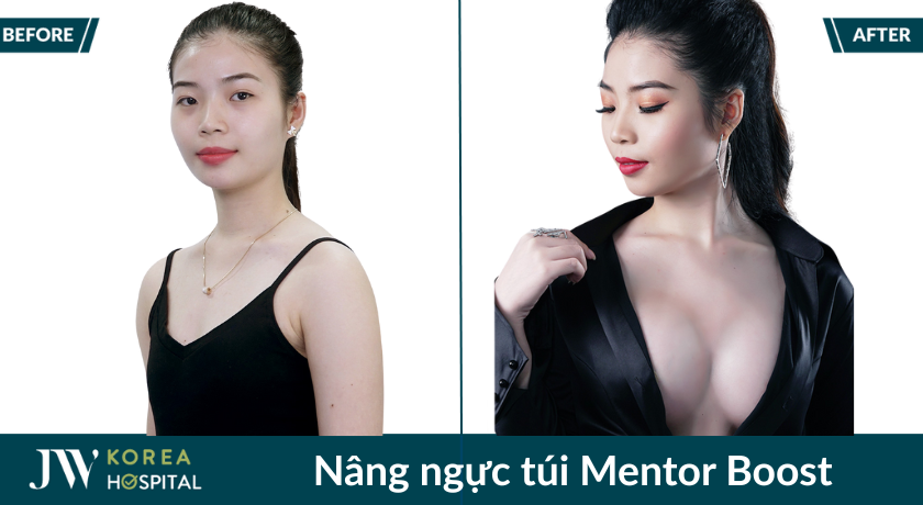 nâng ngực tui ngực mentor boost tại jw