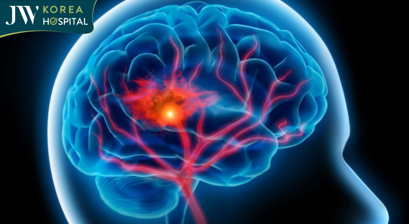 đột quỵ được xem là kẻ giết người thầm lặng 