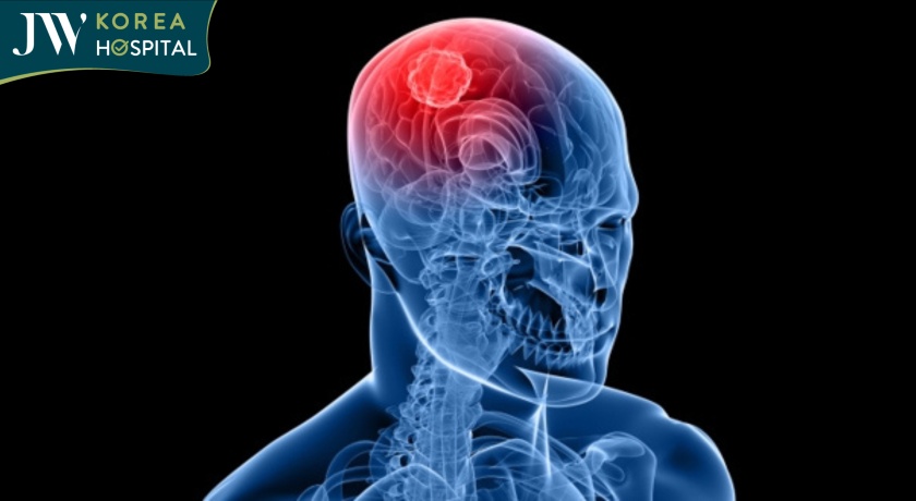 đột quỵ cần được phát hiện sớm để tăng cơ hội sống sót 