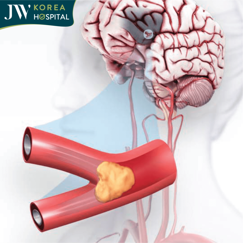 Vỡ mạch máu não