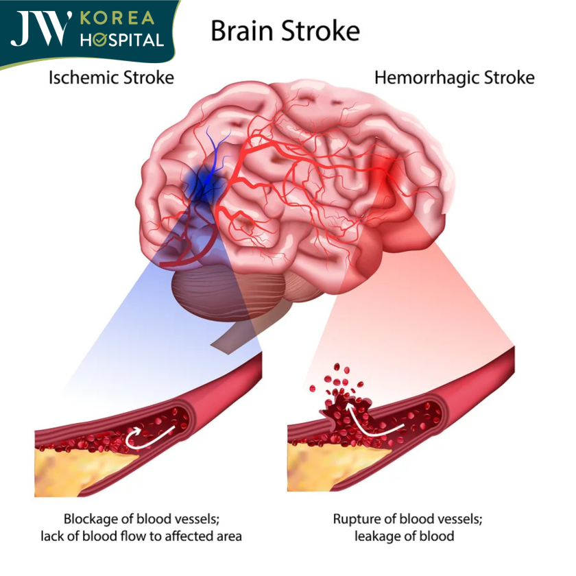 Tình trạng vỡ mạch máu não