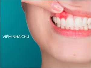 Bệnh nha chu