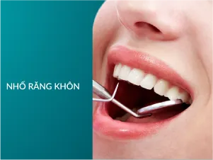 Nhổ răng khôn