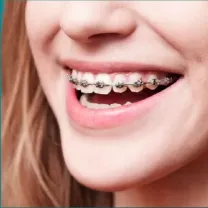 Niềng răng mắc cài kim loại