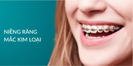 Niềng răng mắc cài kim loại