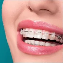 Niềng răng mắc cài thẩm mỹ