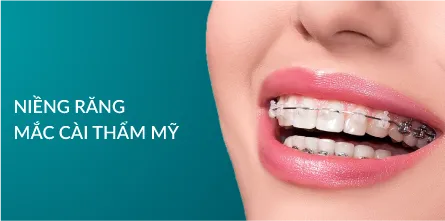Niềng răng mắc cài thẩm mỹ
