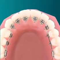 Niềng răng mặt trong