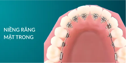 Niềng răng mặt trong
