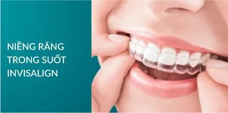 Niềng răng trong suốt Invisalign