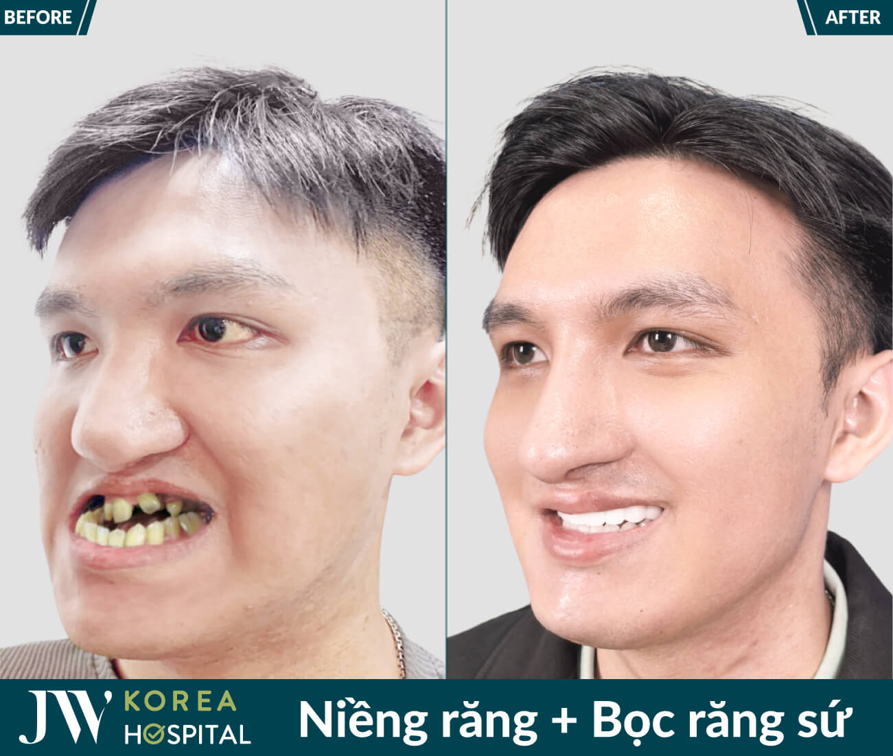 bọc răng sứ sau khi niềng răng tại JW