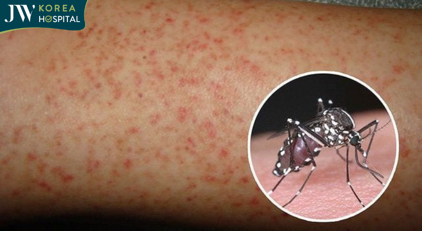 Người bị sốt xuất huyết có thể bị đau đầu, sốt cao đột ngột