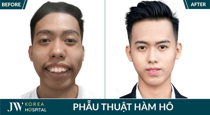 phẫu thuật hàm hô tại JW