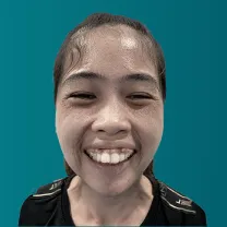 Phẫu thuật hàm hô