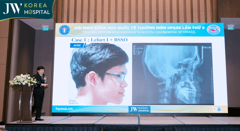 phẫu thuật hàm kết hợp lefort+bsso
