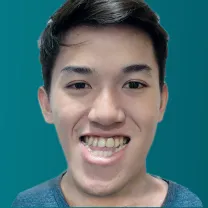 Phẫu thuật hàm móm