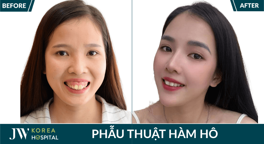 phẫu thuật hàm hô tại JW