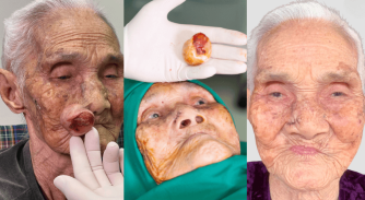 Phép màu tuổi 100: Cụ bà nghẹt thở 30 năm được bác sĩ Tú Dung cứu sống, nay đã có thể mỉm cười và hít thở bình thường