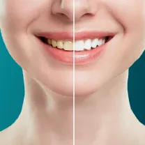 Tẩy Trắng răng