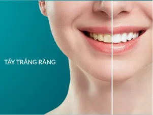 Tẩy Trắng răng