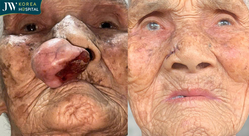 Hình ảnh cụ Lê Thị Khoan 100 tuổi sau khi cắt bỏ khối u mạch máu tại Bệnh viện JW