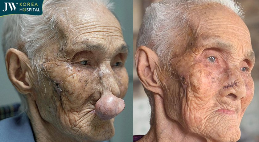 Hình ảnh trước và sau của cụ Lê Thị Khoan sau khi cắt bỏ khối u mạch máu tại Bệnh viện JW Hàn Quốc