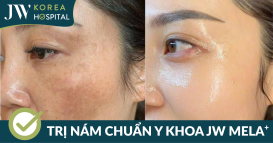 trị nám chuẩn y khoa mela plus tại JW