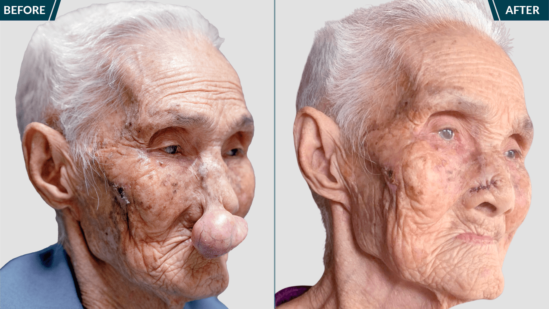 trước và sau cụ khoan cắt khối u bướu quỷ